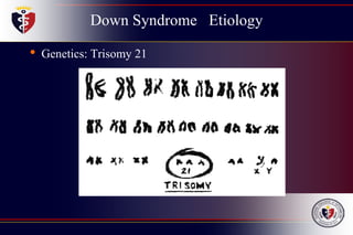 Down Syndrome Etiology
• Genetics: Trisomy 21
 