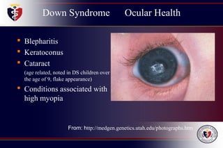Down Syndrome Ocular Health
• Blepharitis
• Keratoconus
• Cataract
(age related, noted in DS children over
the age of 9, flake appearance)
• Conditions associated with
high myopia
From: http://medgen.genetics.utah.edu/photographs.htm
 