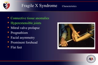 Fragile X Syndrome Characteristics
• Connective tissue anomalies
• Hyperextensible joints
• Mitral valve prolapse
• Prognathism
• Facial asymmetry
• Prominent forehead
• Flat feet
 