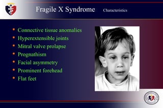 Fragile X Syndrome Characteristics
• Connective tissue anomalies
• Hyperextensible joints
• Mitral valve prolapse
• Prognathism
• Facial asymmetry
• Prominent forehead
• Flat feet
 