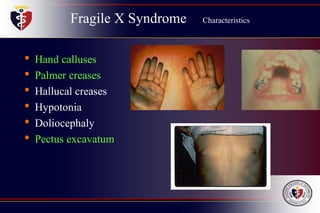Fragile X Syndrome Characteristics
• Hand calluses
• Palmer creases
• Hallucal creases
• Hypotonia
• Doliocephaly
• Pectus excavatum
 