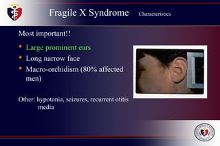 Fragile X Syndrome Characteristics
Most important!!
• Large prominent ears
• Long narrow face
• Macro-orchidism (80% affected
men)
Other: hypotonia, seizures, recurrent otitis
media
 