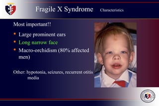Fragile X Syndrome Characteristics
Most important!!
• Large prominent ears
• Long narrow face
• Macro-orchidism (80% affected
men)
Other: hypotonia, seizures, recurrent otitis
media
 