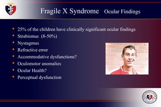 Fragile X Syndrome Ocular Findings
• 25% of the children have clinically significant ocular findings
• Strabismus (8-50%)
• Nystagmus
• Refractive error
• Accommodative dysfunctions?
• Oculomotor anomalies
• Ocular Health?
• Perceptual dysfunction
 