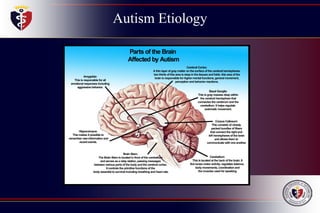 Autism Etiology
 