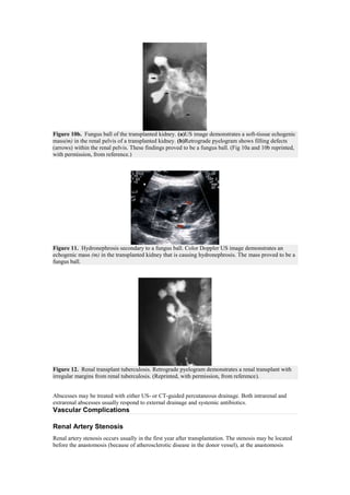 Figure 10b. Fungus ball of the transplanted kidney. (a)US image demonstrates a soft-tissue echogenic
mass(m) in the renal pelvis of a transplanted kidney. (b)Retrograde pyelogram shows filling defects
(arrows) within the renal pelvis. These findings proved to be a fungus ball. (Fig 10a and 10b reprinted,
with permission, from reference.)




Figure 11. Hydronephrosis secondary to a fungus ball. Color Doppler US image demonstrates an
echogenic mass (m) in the transplanted kidney that is causing hydronephrosis. The mass proved to be a
fungus ball.




Figure 12. Renal transplant tuberculosis. Retrograde pyelogram demonstrates a renal transplant with
irregular margins from renal tuberculosis. (Reprinted, with permission, from reference).


Abscesses may be treated with either US- or CT-guided percutaneous drainage. Both intrarenal and
extrarenal abscesses usually respond to external drainage and systemic antibiotics.
Vascular Complications

Renal Artery Stenosis
Renal artery stenosis occurs usually in the first year after transplantation. The stenosis may be located
before the anastomosis (because of atherosclerotic disease in the donor vessel), at the anastomosis
 