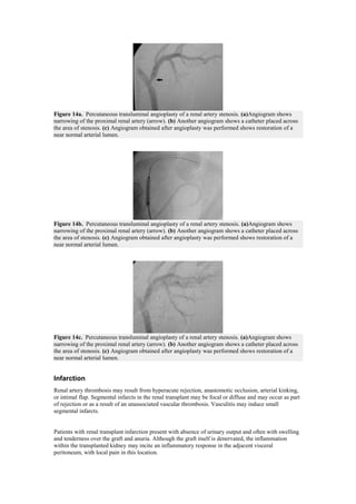 Figure 14a. Percutaneous transluminal angioplasty of a renal artery stenosis. (a)Angiogram shows
narrowing of the proximal renal artery (arrow). (b) Another angiogram shows a catheter placed across
the area of stenosis. (c) Angiogram obtained after angioplasty was performed shows restoration of a
near normal arterial lumen.




Figure 14b. Percutaneous transluminal angioplasty of a renal artery stenosis. (a)Angiogram shows
narrowing of the proximal renal artery (arrow). (b) Another angiogram shows a catheter placed across
the area of stenosis. (c) Angiogram obtained after angioplasty was performed shows restoration of a
near normal arterial lumen.




Figure 14c. Percutaneous transluminal angioplasty of a renal artery stenosis. (a)Angiogram shows
narrowing of the proximal renal artery (arrow). (b) Another angiogram shows a catheter placed across
the area of stenosis. (c) Angiogram obtained after angioplasty was performed shows restoration of a
near normal arterial lumen.


Infarction
Renal artery thrombosis may result from hyperacute rejection, anastomotic occlusion, arterial kinking,
or intimal flap. Segmental infarcts in the renal transplant may be focal or diffuse and may occur as part
of rejection or as a result of an unassociated vascular thrombosis. Vasculitis may induce small
segmental infarcts.


Patients with renal transplant infarction present with absence of urinary output and often with swelling
and tenderness over the graft and anuria. Although the graft itself is denervated, the inflammation
within the transplanted kidney may incite an inflammatory response in the adjacent visceral
peritoneum, with local pain in this location.
 