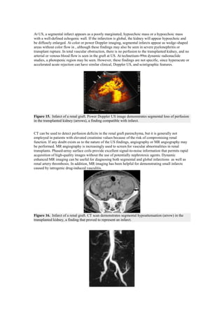 At US, a segmental infarct appears as a poorly marginated, hypoechoic mass or a hypoechoic mass
with a well-defined echogenic wall. If the infarction is global, the kidney will appear hypoechoic and
be diffusely enlarged. At color or power Doppler imaging, segmental infarcts appear as wedge-shaped
areas without color flow in , although these findings may also be seen in severe pyelonephritis or
transplant rupture. In total vascular obstruction, there is no perfusion to the transplanted kidney, and no
arterial or venous blood flow is seen in the graft at US. At technetium-99m dynamic radionuclide
studies, a photopenic region may be seen. However, these findings are not specific, since hyperacute or
accelerated acute rejection can have similar clinical, Doppler US, and scintigraphic features.




Figure 15. Infarct of a renal graft. Power Doppler US image demonstrates segmental loss of perfusion
in the transplanted kidney (arrows), a finding compatible with infarct.


CT can be used to detect perfusion deficits in the renal graft parenchyma, but it is generally not
employed in patients with elevated creatinine values because of the risk of compromising renal
function. If any doubt exists as to the nature of the US findings, angiography or MR angiography may
be performed. MR angiography is increasingly used to screen for vascular abnormalities in renal
transplants. Phased-array surface coils provide excellent signal-to-noise information that permits rapid
acquisition of high-quality images without the use of potentially nephrotoxic agents. Dynamic
enhanced MR imaging can be useful for diagnosing both segmental and global infarctions as well as
renal artery thrombosis. In addition, MR imaging has been helpful for demonstrating small infarcts
caused by iatrogenic drug-induced vasculitis.




Figure 16. Infarct of a renal graft. CT scan demonstrates segmental hypoattenuation (arrow) in the
transplanted kidney, a finding that proved to represent an infarct.
 
