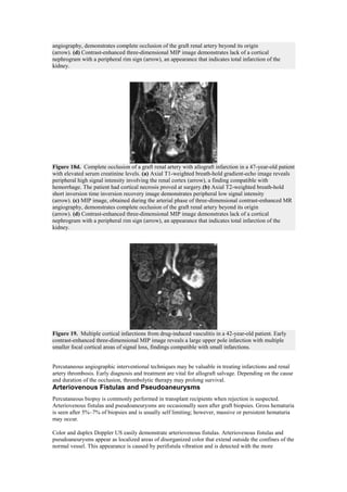 angiography, demonstrates complete occlusion of the graft renal artery beyond its origin
(arrow). (d) Contrast-enhanced three-dimensional MIP image demonstrates lack of a cortical
nephrogram with a peripheral rim sign (arrow), an appearance that indicates total infarction of the
kidney.




Figure 18d. Complete occlusion of a graft renal artery with allograft infarction in a 47-year-old patient
with elevated serum creatinine levels. (a) Axial T1-weighted breath-hold gradient-echo image reveals
peripheral high signal intensity involving the renal cortex (arrow), a finding compatible with
hemorrhage. The patient had cortical necrosis proved at surgery.(b) Axial T2-weighted breath-hold
short inversion time inversion recovery image demonstrates peripheral low signal intensity
(arrow). (c) MIP image, obtained during the arterial phase of three-dimensional contrast-enhanced MR
angiography, demonstrates complete occlusion of the graft renal artery beyond its origin
(arrow). (d) Contrast-enhanced three-dimensional MIP image demonstrates lack of a cortical
nephrogram with a peripheral rim sign (arrow), an appearance that indicates total infarction of the
kidney.




Figure 19. Multiple cortical infarctions from drug-induced vasculitis in a 42-year-old patient. Early
contrast-enhanced three-dimensional MIP image reveals a large upper pole infarction with multiple
smaller focal cortical areas of signal loss, findings compatible with small infarctions.


Percutaneous angiographic interventional techniques may be valuable in treating infarctions and renal
artery thrombosis. Early diagnosis and treatment are vital for allograft salvage. Depending on the cause
and duration of the occlusion, thrombolytic therapy may prolong survival.
Arteriovenous Fistulas and Pseudoaneurysms
Percutaneous biopsy is commonly performed in transplant recipients when rejection is suspected.
Arteriovenous fistulas and pseudoaneurysms are occasionally seen after graft biopsies. Gross hematuria
is seen after 5%–7% of biopsies and is usually self limiting; however, massive or persistent hematuria
may occur.

Color and duplex Doppler US easily demonstrate arteriovenous fistulas. Arteriovenous fistulas and
pseudoaneurysms appear as localized areas of disorganized color that extend outside the confines of the
normal vessel. This appearance is caused by perifistula vibration and is detected with the more
 