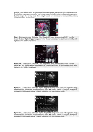 sensitive color Doppler units. Arteriovenous fistulas also appear as abnormal high-velocity turbulent
flow isolated to a single segmental or interlobar artery and paired vein that produces aliasing on color
Doppler images. The feeding artery shows a high-velocity low-resistance waveform, and the draining
vein demonstrates arterialization.




Figure 20a. Arteriovenous fistula. (a) Color Doppler US image demonstrates a highly vascular
lesion. (b) Color duplex Doppler image shows the classic waveform of an arteriovenous fistula, with
high velocities and low impedance.




Figure 20b. Arteriovenous fistula. (a) Color Doppler US image demonstrates a highly vascular
lesion. (b) Color duplex Doppler image shows the classic waveform of an arteriovenous fistula, with
high velocities and low impedance.




Figure 21a. Arteriovenous fistula. (a) Duplex Doppler US image of the lower pole segmental artery
shows increased velocity and decreased resistive index.(b) Duplex Doppler US image of the adjacent
vein shows arterialization of flow, a finding consistent with arteriovenous fistula.




Figure 21b. Arteriovenous fistula. (a) Duplex Doppler US image of the lower pole segmental artery
shows increased velocity and decreased resistive index.(b) Duplex Doppler US image of the adjacent
vein shows arterialization of flow, a finding consistent with arteriovenous fistula.
 
