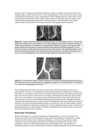 On gray-scale US images, pseudoaneurysms appear as simple or complex renal cysts, but with color
imaging, highly vascular intracystic flow is seen. Pseudoaneurysms with a narrow neck and no venous
communication demonstrate a classic machinelike to-and-fro Doppler spectrum at their necks. Those
associated with arteriovenous fistulas exhibit a high-velocity low-resistance spectrum at their necks,
with minimally pulsatile high-velocity flow in the draining vein. When the degree of perifistula
vibration limits US assessment of the vascular anatomy, MR imaging enables evaluation.




Figure 22. Arteriovenous fistula following transplant biopsy. A color Doppler study in a 41-year-old
hypertensive patient with a bruit audited over the renal allograft revealed tissue vibration. Because of
marked tissue vibration, it was difficult to interrogate the transplant vasculature. Non-targeted MIP
images during the arterial phase of contrast-enhanced three-dimensional MR angiography reveal a
focal severe stenosis of the graft renal artery beyond its origin (arrow). The transplanted renal venous
system is enhancing during the early arterial phase along with the iliac vasculature and inferior vena
cava. The cortical nephrogram is very faint due to the marked arteriovenous shunting.




Figure 23. Arteriovenous fistula. Contrast-enhanced three-dimensional MR angiogram demonstrates
the renal artery and veins simultaneously, an appearance suggestive of fistula formation. The diagnosis
was confirmed at angiography (not shown).


Most complications after biopsy are treated conservatively, and most pseudoaneurysms resolve
spontaneously. If, however, a pseudoaneurysm demonstrates progressive enlargement or unusual size
(more than 2 cm in diameter), intervention is warranted. Selective transvascular catheterization may be
used. The size and location of the arteriovenous fistula or pseudoaneurysm determine which embolic
agent to use. For example, a large arteriovenous malformation is more easily treated with steel coils,
since particulate matter such as absorbable gelatin sponge (Gelfoam) may pass through the fistulous
communication and embolize the systemic circulation. Peripheral lesions may be difficult to catheterize
selectively, but a flow-directed detachable balloon can be delivered to the site. Microcatheter systems
may also be helpful for superselective embolization of small, peripheral feeding vessels. In treatment of
transplant-related arteriovenous fistulas (unlike that of peripheral arteriovenous fistulas), occlusion of
the proximal bleeding vessel is sufficient.

Renal Vein Thrombosis
Renal vein thrombosis is an unusual complication of transplantation; it occurs in less than 5% of
patients and usually in the first postoperative week. Renal vein thrombosis is heralded by an abrupt
cessation of urinary function and swelling and tenderness over the graft. Hypovolemia, venous
compression from a peritransplant fluid collection, dysfunctional anastomosis, and slow flow
secondary to rejection or other allograft disease can also precipitate renal vein thrombosis. An
increased prevalence of renal vein thrombosis in left lower quadrant allografts has also been attributed
 