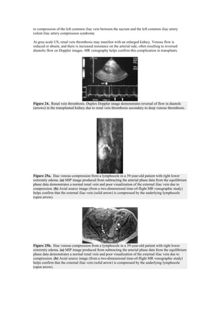 to compression of the left common iliac vein between the sacrum and the left common iliac artery
(silent iliac artery compression syndrome.

At gray-scale US, renal vein thrombosis may manifest with an enlarged kidney. Venous flow is
reduced or absent, and there is increased resistance on the arterial side, often resulting in reversed
diastolic flow on Doppler images. MR venography helps confirm this complication in transplants.




Figure 24. Renal vein thrombosis. Duplex Doppler image demonstrates reversal of flow in diastole
(arrows) in the transplanted kidney due to renal vein thrombosis secondary to deep venous thrombosis.




Figure 25a. Iliac venous compression from a lymphocele in a 39-year-old patient with right lower
extremity edema. (a) MIP image produced from subtracting the arterial phase data from the equilibrium
phase data demonstrates a normal renal vein and poor visualization of the external iliac vein due to
compression. (b) Axial source image (from a two-dimensional time-of-flight MR venographic study)
helps confirm that the external iliac vein (solid arrow) is compressed by the underlying lymphocele
(open arrow).




Figure 25b. Iliac venous compression from a lymphocele in a 39-year-old patient with right lower
extremity edema. (a) MIP image produced from subtracting the arterial phase data from the equilibrium
phase data demonstrates a normal renal vein and poor visualization of the external iliac vein due to
compression. (b) Axial source image (from a two-dimensional time-of-flight MR venographic study)
helps confirm that the external iliac vein (solid arrow) is compressed by the underlying lymphocele
(open arrow).
 