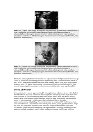 Figure 1b. Urinoma from ruptured ureterovesical junction stenosis. (a) Gray-scale sonogram reveals a
renal transplant that is obstructed because of a ruptured ureterovesical anastomosis and an
urinoma. (b) Postvoid sonogram demonstrates a fluid collection that represents extravasated urine
(arrow) and a small bladder (BL). (c) Cystogram demonstrates extravasation (arrow). (Reprinted, with
permission, from reference 5.)




Figure 1c. Urinoma from ruptured ureterovesical junction stenosis. (a) Gray-scale sonogram reveals a
renal transplant that is obstructed because of a ruptured ureterovesical anastomosis and an
urinoma. (b) Postvoid sonogram demonstrates a fluid collection that represents extravasated urine
(arrow) and a small bladder (BL). (c) Cystogram demonstrates extravasation (arrow). (Reprinted, with
permission, from reference 5.)


Small urine leaks may be treated with percutaneous nephrostomy and stent placement. Caliceal leakage
caused by infarction is treated with percutaneous nephrostomy alone. Ureteral stents must be kept in
place for 6–8 weeks after cessation of leakage to allow complete healing of the ureter and to preserve
long-term patency. If healing is unsuccessful, reimplantation of the ureter may be required; if distal
necrosis is present, pyelocystostomy or pyeloureterostomy with the native ureter is performed (6).

Urinary Obstruction
Urinary obstruction occurs in approximately 2% of transplantations and almost always within the first
6 months after the procedure. Obstruction of the transplanted kidney may occur at any location but is
most frequent at the site of implantation of the ureter into the bladder. More than 90% of ureteral
stenoses occur within the distal third of the ureter. Narrowing at the ureterovesical junction may be
caused by scarring secondary to ischemia or rejection, by technical error during the
ureteroneocystostomy, or by kinking. These events account for more than 50% of obstructions that
cause ureteral stricture. Less common causes include pelvic fibrosis, calculi, papillary necrosis, fungus
ball, clots, and compression from an extrinsic mass such as adjacent peritransplant collections.
Occasionally, obstruction that develops years after transplantation—especially in patients who have
undergone multiple procedures—may be related to adhesions, vascular insufficiency, or fibrosis.
 