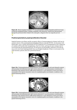 Figure 28. Renal transplant herniation. CT scan demonstrates multiple distended small bowel loops
around the transplanted kidney, findings compatible with obstruction. Small bowel had herniated
through the peritoneal defect related to the renal graft, a diagnosis that was surgically proved.


PosttransplantationLymphoproliferative Disorder

Impaired immune surveillance and the oncogenic effects of immunosuppressive therapy itself may be
causative factors of the posttransplantationlymphoproliferative disorder (PLTD). An association with
Epstein Barr virus is usually demonstrated. PLTD complicates 8% of transplantations and is diagnosed
at a median of 80 months after transplantation. The liver, brain, and lung are more common sites of
involvement than the gastrointestinal tract. PLTD lesions are polymorphic collections of B cells but
may evolve into forms indistinguishable from non-Hodgkin lymphoma. If there is involvement of the
small intestines, patients often have generalized disease.




Figure 29a. Posttransplantationlymphoproliferative disease in a 25-year-old renal allograft recipient
who presented with abdominal pain. (a) Contrast-enhanced CT scan demonstrates circumferential
thickening of the jejunum (arrows). (b)Contrast-enhanced CT scan obtained at a lower level shows
encasement of the superior mesenteric artery by lymphadenopathy (arrowheads), in addition to the
jejunal thickening (arrow).




Figure 29b. Posttransplantationlymphoproliferative disease in a 25-year-old renal allograft recipient
who presented with abdominal pain. (a) Contrast-enhanced CT scan demonstrates circumferential
thickening of the jejunum (arrows). (b)Contrast-enhanced CT scan obtained at a lower level shows
encasement of the superior mesenteric artery by lymphadenopathy (arrowheads), in addition to the
jejunal thickening (arrow).
 