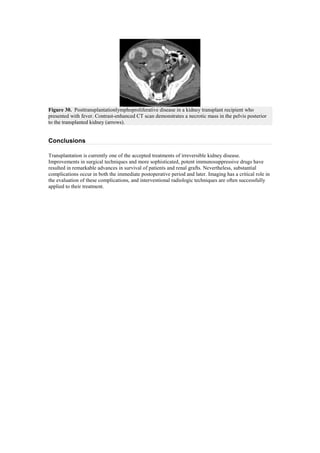 Figure 30. Posttransplantationlymphoproliferative disease in a kidney transplant recipient who
presented with fever. Contrast-enhanced CT scan demonstrates a necrotic mass in the pelvis posterior
to the transplanted kidney (arrows).


Conclusions

Transplantation is currently one of the accepted treatments of irreversible kidney disease.
Improvements in surgical techniques and more sophisticated, potent immunosuppressive drugs have
resulted in remarkable advances in survival of patients and renal grafts. Nevertheless, substantial
complications occur in both the immediate postoperative period and later. Imaging has a critical role in
the evaluation of these complications, and interventional radiologic techniques are often successfully
applied to their treatment.
 