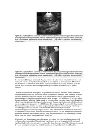 Figure 2a. Hydronephrosis secondary to ureteral stricture. (a) Gray-scale sonogram demonstrates mild
hydronephrosis secondary to ureteral stricture. (b)Retrograde pyelogram shows the area of narrowing
at the site of ureteral implantation into the bladder (arrow). (Fig 2a and 2b reprinted, with permission,
from reference5.)




Figure 2b. Hydronephrosis secondary to ureteral stricture. (a) Gray-scale sonogram demonstrates mild
hydronephrosis secondary to ureteral stricture. (b)Retrograde pyelogram shows the area of narrowing
at the site of ureteral implantation into the bladder (arrow). (Fig 2a and 2b reprinted, with permission,
from reference).
The transplanted kidney is denervated; thus, the patient will not complain of typical renal colic when
obstruction occurs. Urinary obstruction manifests by a rising level of serum creatinine. Obstruction
may be difficult to differentiate from chronic rejection, since both cause rising creatinine levels. In
addition, mild dilatation of the collecting system may occasionally be seen in cases of chronic
rejection.


US can be used to confirm the diagnosis of hydronephrosis; however, intrarenal edema and fibrosis
associated with rejection may prevent the normal hydronephrotic response. Some transplant recipients
may have substantial obstruction but little or no renal dilatation. Mild to moderate dilatation of the
transplanted pyelocaliceal system and ureter may occur secondary to a full bladder. In all cases, when
the patient’s bladder is full, the bladder should be emptied and the transplant imaged again. In addition,
a denervated, transplanted collecting system has no tone; thus, any transient episode of hydronephrosis
may cause a persistent appearance of mild dilatation. The single renal graft is responsible for excreting
the entire urine output from the transplant recipient’s body, and, over time, increasing output may
exacerbate pelvocaliectasis. Studies have attempted to differentiate obstructive from
nonobstructivepyelocaliectasis by using the resistive index. Extrapolation of these results from native
to transplanted kidneys has not, however, been entirely successful. US also demonstrateslymphoceles,
hematomas, abscesses, and urinomas that may cause ureteral obstruction. Any echogenicity within a
dilated collecting system is usually clinically significant.

Scintigraphy may demonstrate urinary obstruction. In a patient with early partial obstruction, good
perfusion and prompt uptake of the radiotracer may be seen; however, in a patient with functionally
significant hydronephrosis, radioactivity is retained in the collecting system. Delayed images (obtained
2–4 hours after injection) are useful for differentiating an obstructed ureter from a dilated but
 