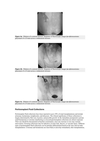 Figure 4a. Dilation of a ureteral stenosis. Sequence of fluoroscopic images (a–c)demonstrates
placement of a JJ stent across a midureteral stricture.




Figure 4b. Dilation of a ureteral stenosis. Sequence of fluoroscopic images (a–c)demonstrates
placement of a JJ stent across a midureteral stricture.




Figure 4c. Dilation of a ureteral stenosis. Sequence of fluoroscopic images (a–c)demonstrates
placement of a JJ stent across a midureteral stricture.


Peritransplant Fluid Collections

Peritransplant fluid collections have been reported in up to 50% of renal transplantations and include
urinomas, hematomas, lymphoceles, and abscesses. The clinical significance of these collections is
largely determined by their size, location, and possible growth. In the immediate postoperative period,
small hematomas or seromas manifesting as crescenticperitransplant collections are almost expected.
Their size should be documented at baseline examination, since any increase in size may warrant
intervention. Growing collections may be indicative of urine leak, abscess, or vascular injury. Different
types of peritransplant fluid collections can be partially differentiated based on the time interval after
transplantation. Urinomas and hematomas are most likely to develop immediately after transplantation,
 
