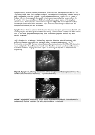 Lymphoceles are the most common peritransplant fluid collections, with a prevalence of 0.5%–20%.
They may develop at any time, from weeks to years after transplantation. However, they are usually an
early complication, occurring within 1–2 months after transplantation. Lymphoceles are caused by
leakage of lymph from surgically disrupted lymphatic channels along the iliac vessels or from the
lymphatics of the transplanted kidney. Risk factors include inadequate ligation of the lymphatic
channels across the iliac vessels, administration of heparin, and possibly increased lymphatic flow
secondary to edema of the lower extremities. These fluid collections usually occur medial to the
transplant, between the graft and the bladder .

Lymphoceles are the most common fluid collection that causes transplant hydronephrosis. Patients with
a failing allograft may develop ipsilateral lower extremity edema caused by compression of the femoral
vein. In rare cases, lymphoceles may develop in the scrotum and lymphatic drainage may occur
through the wound.


At US, lymphoceles are anechoic) and may have septations. Similar to other peritransplant fluid
collections, they can become infected and can develop a more complex appearance . At CT,
lymphoceles have variable characteristics and are usually sharply circumscribed. Their CT attenuation
values are typical of those of water and usually lower than those of recent hematomas and abscesses.
Radionuclide and MR imaging studies are helpful for excluding the presence of urine and blood,
respectively.




Figure 6. Lymphocele. US image demonstrates mild hydronephrosis of the transplanted kidney. The
anechoic area represents a lymphocele (L) adjacent to the kidney.




Figure 7. Lymphocele. Sonogram of another patient shows a multilocular fluid collection (arrows)
that surrounds the renal transplant. The collection proved to be a lymphocele.
 