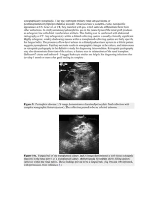 sonographically nonspecific. They may represent primary renal cell carcinoma or
posttransplantationlymphoproliferative disorder. Abscesses have a complex, cystic, nonspecific
appearance at US; however, at CT, they manifest with gas, which serves to differentiate them from
other collections. In emphysematous pyelonephritis, gas in the parenchyma of the renal graft produces
an echogenic line with distal reverberation artifacts. This finding can be confirmed with abdominal
radiography or CT. Any echogenicity within a dilated collecting system is usually clinically significant.
Highly echogenic, weakly shadowing masses within a transplanted collecting system are fairly specific
for fungus balls). The presence of low-level echoes in a dilated pyelocaliceal system in a febrile patient
suggests pyonephrosis. Papillary necrosis results in sonographic changes in the calices, and intravenous
or retrograde pyelography is the definitive study for diagnosing this condition. Retrograde pyelography
may also demonstrate distortion of the calices, a feature seen in tuberculosis of the renal transplant.
Gallium-67 citrate and indium-111–tagged leukocyte studies are helpful for diagnosing infections that
develop 1 month or more after graft healing is complete .




Figure 9. Perinephric abscess. US image demonstrates a loculatedperinephric fluid collection with
complex sonographic features (arrow). The collection proved to be an infected urinoma.




Figure 10a. Fungus ball of the transplanted kidney. (a)US image demonstrates a soft-tissue echogenic
mass(m) in the renal pelvis of a transplanted kidney. (b)Retrograde pyelogram shows filling defects
(arrows) within the renal pelvis. These findings proved to be a fungus ball. (Fig 10a and 10b reprinted,
with permission, from reference 5.)
 