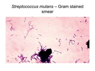 Streptococcus mutans – Gram stained 
smear 
 