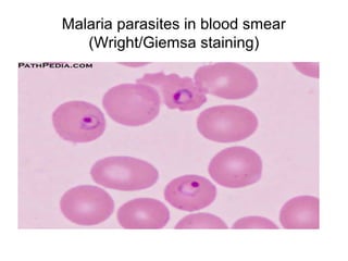 Malaria parasites in blood smear 
(Wright/Giemsa staining) 
 
