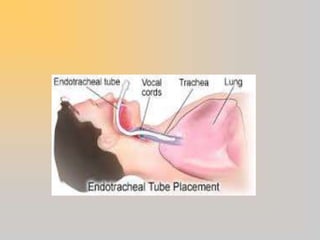 Maintaining patent airway | PPT