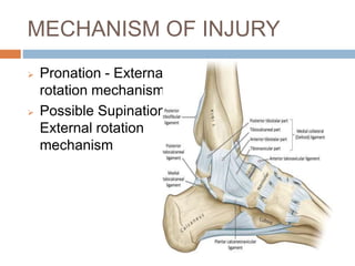 Maisonneuve fracture of ankle joint