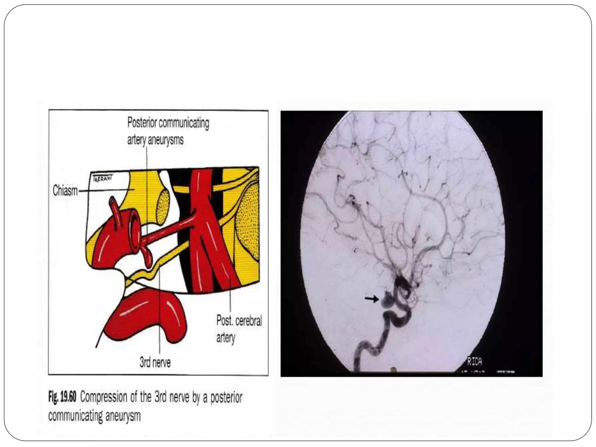 3rd nerve palsy | PPTX