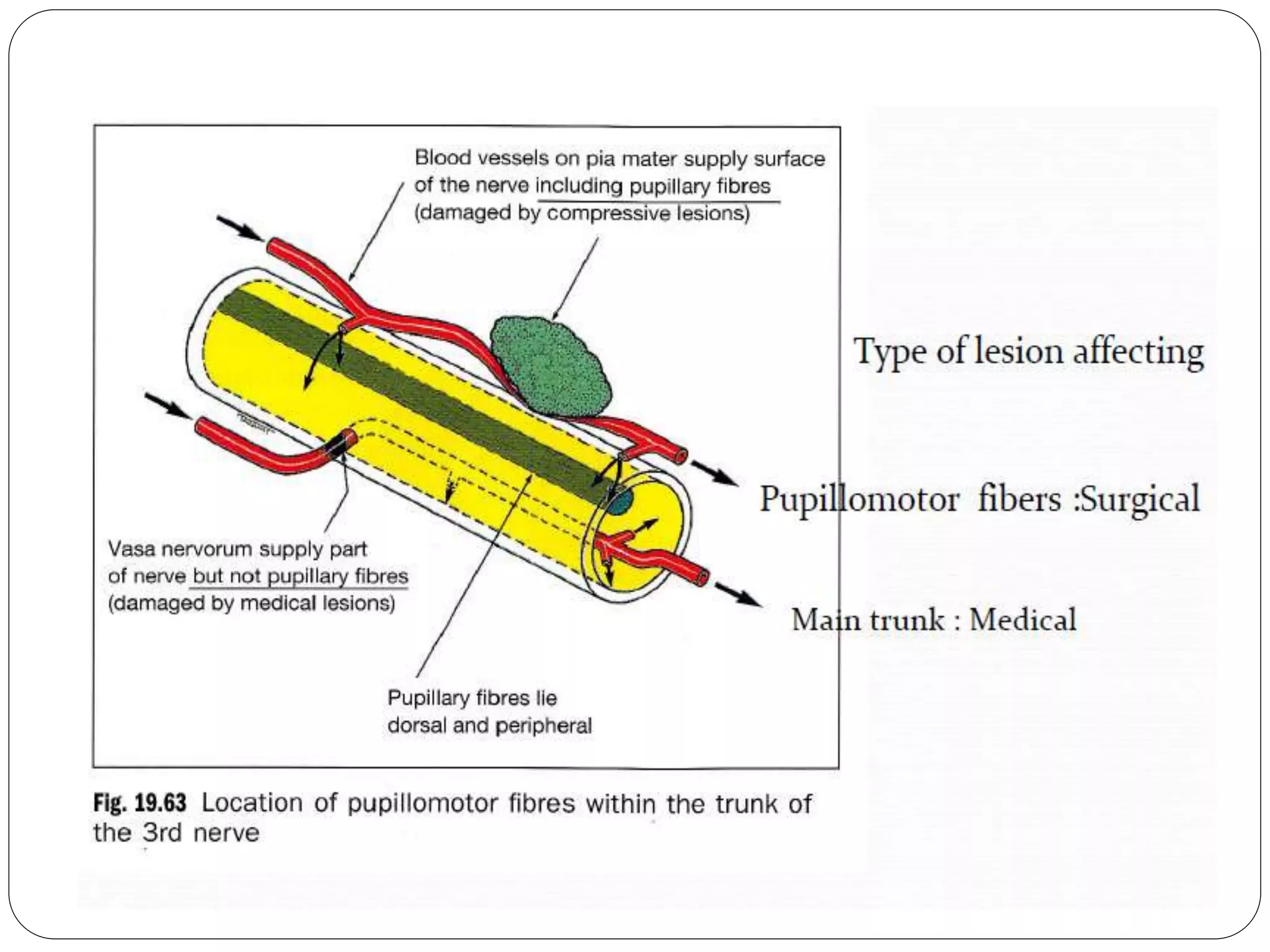 3rd nerve palsy | PPTX