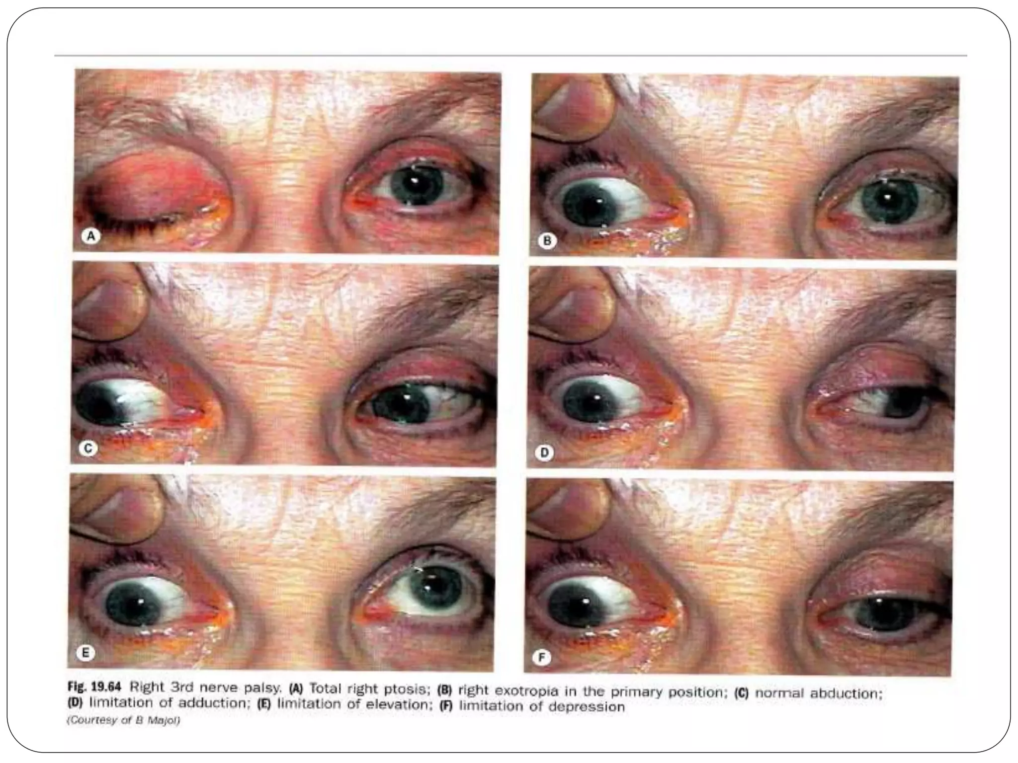 3rd nerve palsy | PPTX