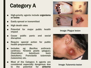 Category A
■ High-priority agents include organisms
or toxins
■ Easily spread or transmitted
■ High death rates
■ Potential for major public health
impact
■ Cause public panic and social
disruption
■ Require special action for public
health preparedness.
■ Includes eg. Bacillus anthracis
(anthrax); Yersinia pestis (plague);
Clostridium botulinum toxin
(botulism); Francisella tularensis
(tularemia) etc.
■ Most of the Category A agents are
considered especially dangerous due
to the potential for airborne
Image: Plague lesion
Image: Tularemia lesion
 