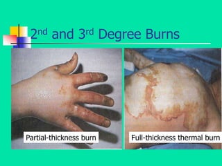 2nd and 3rd Degree Burns
Partial-thickness burn Full-thickness thermal burn
 