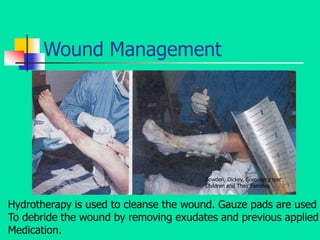Wound Management
Bowden, Dickey, Greenberg text
Children and Their Families
Hydrotherapy is used to cleanse the wound. Gauze pads are used
To debride the wound by removing exudates and previous applied
Medication.
 