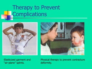 Therapy to Prevent
Complications
Elasticized garment and
“air-plane” splints.
Physical therapy to prevent contracture
deformity.
 