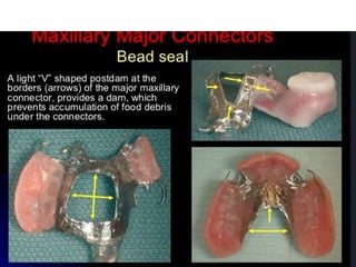 Major connector removable partial denture | PPTX