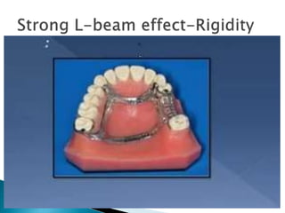 Major connector removable partial denture | PPTX