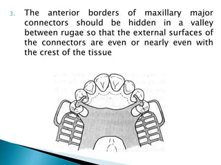 Major connector removable partial denture | PPTX