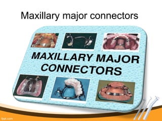 Maxillary major connectors
 