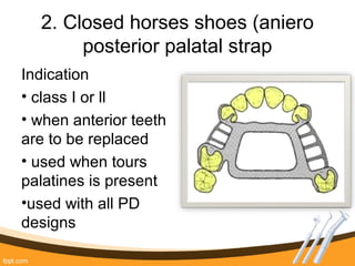 2. Closed horses shoes (aniero
posterior palatal strap
Indication
• class I or ll
• when anterior teeth
are to be replaced
• used when tours
palatines is present
•used with all PD
designs
 