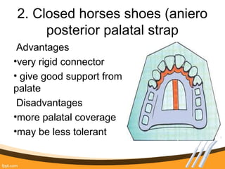 2. Closed horses shoes (aniero
posterior palatal strap
Advantages
•very rigid connector
• give good support from
palate
Disadvantages
•more palatal coverage
•may be less tolerant
 