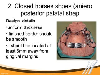 2. Closed horses shoes (aniero
posterior palatal strap
Design details
•uniform thickness
• finished border should
be smooth
•it should be located at
least 6mm away from
gingival margins
 