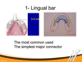 1- Lingual bar
The most common used
The simplest major connector
 