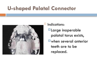 MAJOR connectors.pptx of removable partial denture | PPTX