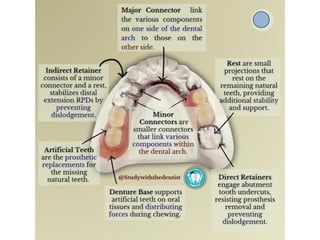 MAJOR connectors.pptx of removable partial denture | PPTX