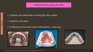• Complete cast metal plate covering the entire palate.
• Complete resin plate.
• Combination of anterior metal with posterior resin area.
Department of prosthodontics, crown & bridge and oral implantology, DDCH, Udaipur 38
DESIGN
TYPES OF PALATAL PLATES
 