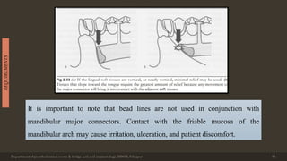 Department of prosthodontics, crown & bridge and oral implantology, DDCH, Udaipur 51
REQUIREMENTS
It is important to note that bead lines are not used in conjunction with
mandibular major connectors. Contact with the friable mucosa of the
mandibular arch may cause irritation, ulceration, and patient discomfort.
 