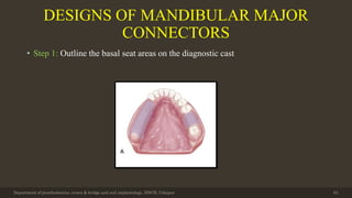 DESIGNS OF MANDIBULAR MAJOR
CONNECTORS
• Step 1: Outline the basal seat areas on the diagnostic cast
Department of prosthodontics, crown & bridge and oral implantology, DDCH, Udaipur 63
 