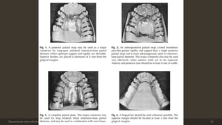 Department of prosthodontics, crown & bridge and oral implantology, DDCH, Udaipur 72
 