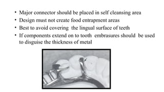 Comprehensive Overview of Major Connectors in Partial Dentures: Design ...