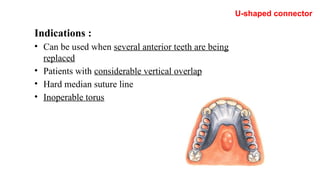Comprehensive Overview of Major Connectors in Partial Dentures: Design ...